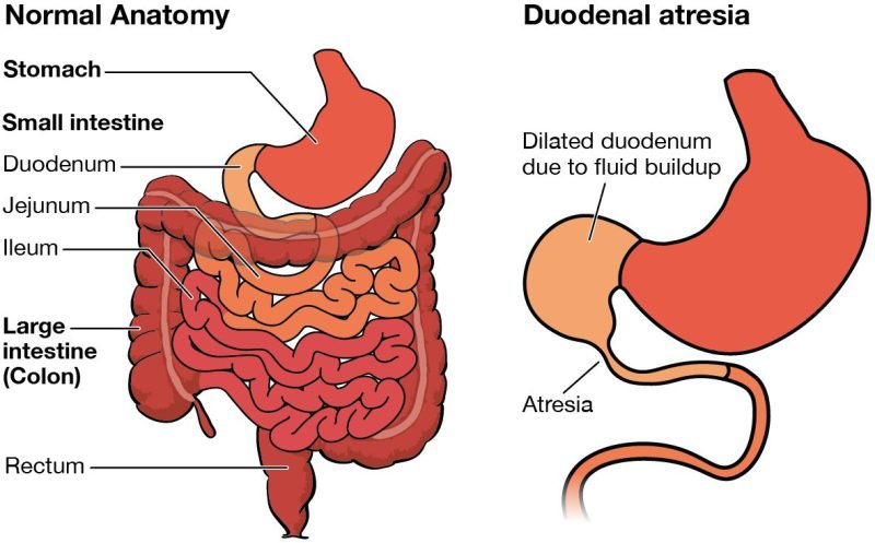 Dilated Bowel Loops के लक्षण (विस्तारित आंत लूपों के लक्षण)