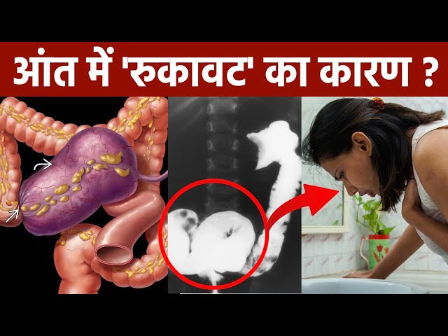 Dilated Bowel Loops के कारण (विस्तारित आंत लूपों के कारण)