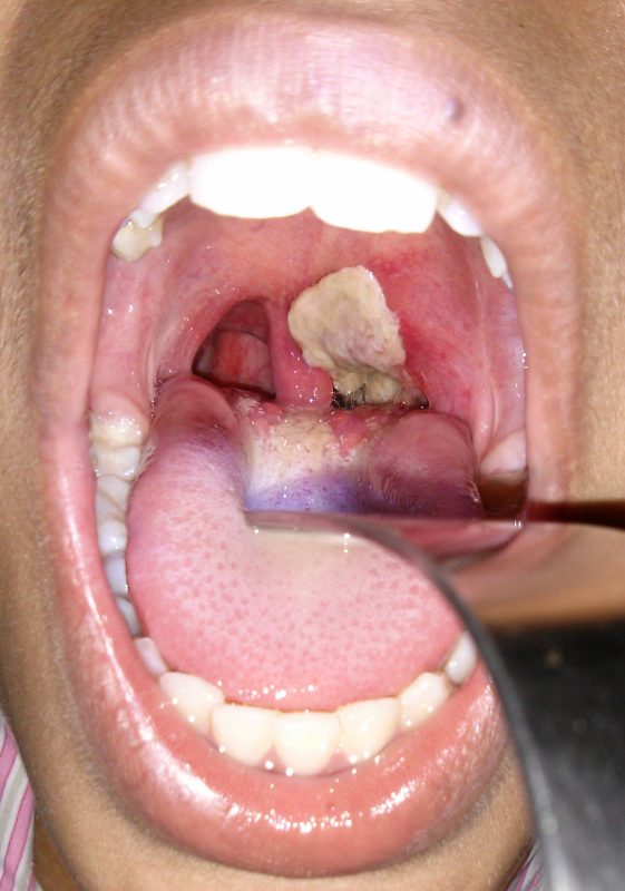 डिप्थीरिया का हिंदी में अर्थ (Diphtheria Ka Hindi Mein Arth)