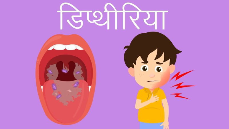 डिप्थीरिया का निदान (Diphtheria Ka Nidan)