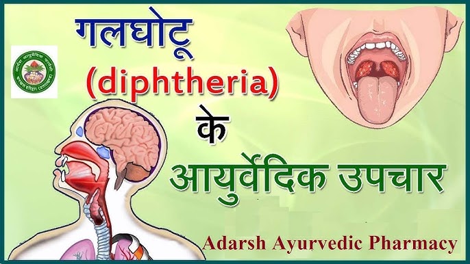 डिप्थीरिया का इलाज (Diphtheria Ka Ilaaj)