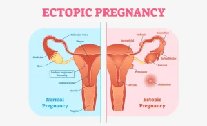 ectopic pregnancy meaning in hindi 2