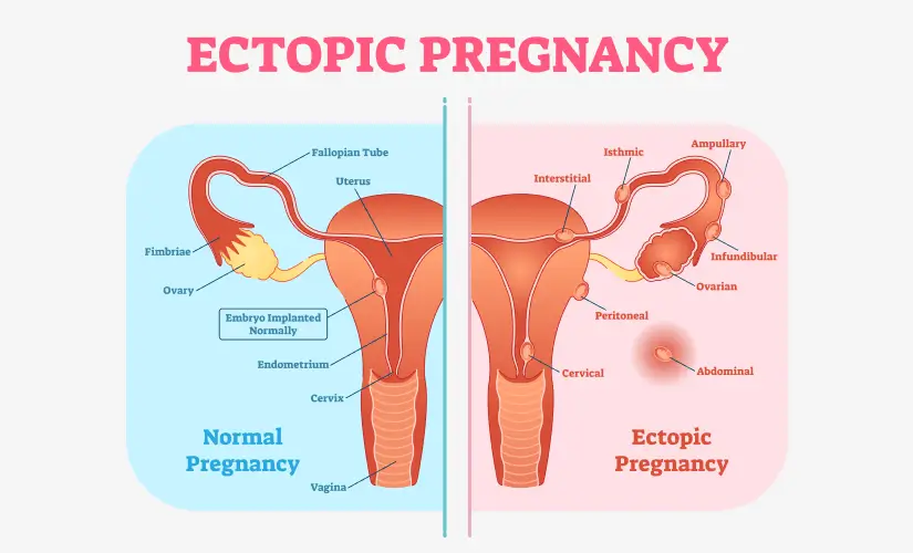 अस्थानिक गर्भावस्था कहाँ होती है? (Where Does Ectopic Pregnancy Occur?)