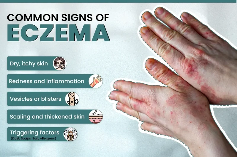 एक्जिमा के लक्षण: कैसे पहचानें? (Eczema ke lakshan: Kaise pehchane?)
