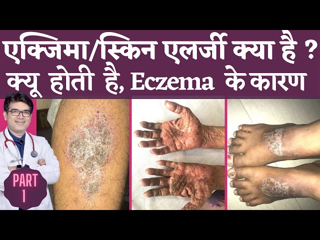 एक्जिमा के कारण: क्या ट्रिगर करता है? (Eczema ke karan: Kya trigger karta hai?)