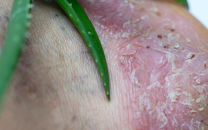 एक्जिमा का इलाज: हिंदी में घरेलू उपचार और चिकित्सा विकल्प (Eczema ka ilaaj: Hindi mein gharelu upchar aur chikitsa vikalp)