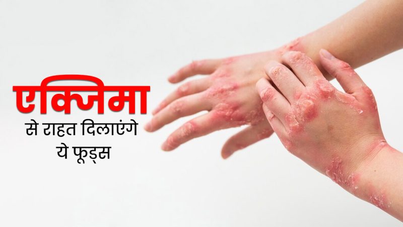एक्जिमा से बचाव: हिंदी में टिप्स और सावधानियां (Eczema se bachav: Hindi mein tips aur savdhaniyan)