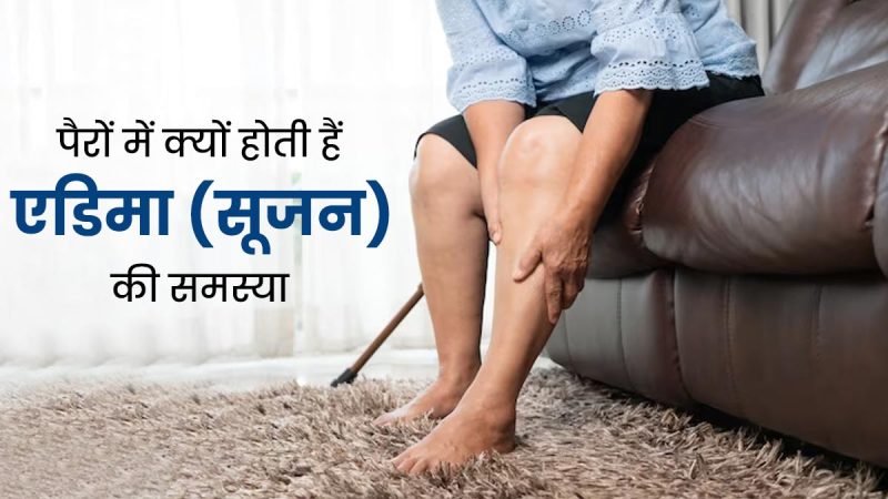 एडिमा का अर्थ हिंदी में: सूजन को समझें  Edema ka arth Hindi mein: Sujan ko samjhen
