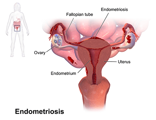 एंडोमेट्रियम की परतें: कार्यात्मक परत बनाम बेसल परत (Endometrium ki partein: Karyatmak parat banam basal parat)