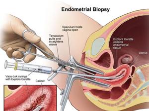 एंडोमेट्रियोसिस: एंडोमेट्रियम से जुड़ी समस्याएं और बीमारियाँ (Endometriosis: Endometrium se judi samasyayen aur bimariyan)