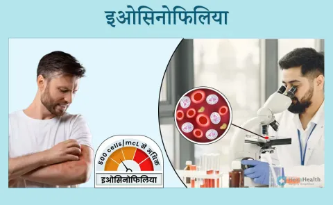 निम्न ईोसिनोफिल काउंट के कारण (Nimn Eosinophil Count Ke Karan)
