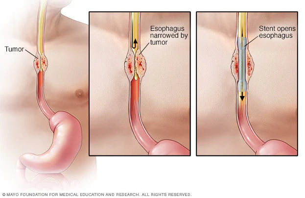 ग्रासनली के स्वास्थ्य के लिए आहार और जीवनशैली सुझाव (Esophagus Health Tips): खाद्य पदार्थ और आदतें