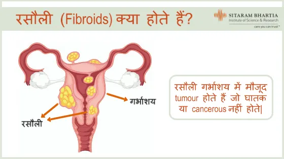 फाइब्रॉइड के स्थान और प्रकारों का चित्रण