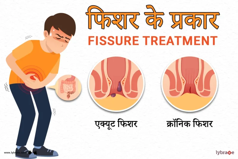 फिस्सुर (Fissure) क्या है? अर्थ, प्रकार और चिकित्सा