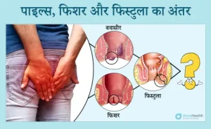 fissure meaning in hindi 4