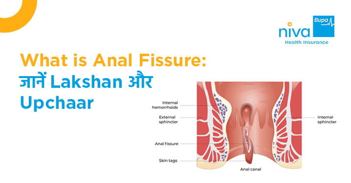 Fissure शब्द का विभिन्न संदर्भों में उपयोग
