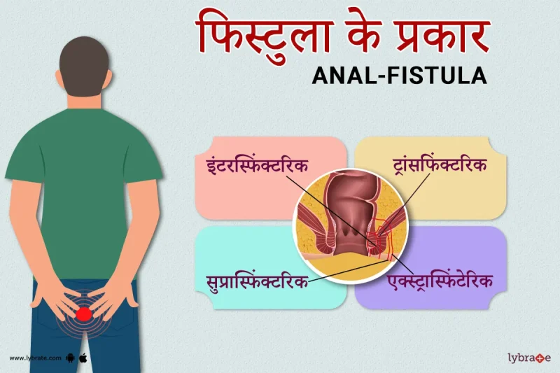 फिस्टुला (Fistula) क्या है, इसके प्रकार क्या हैं और हिंदी में इसका मतलब क्या होता है, इस बारे में विस्तृत जानकारी। यह खंड फिस्टुला के बारे में एक बुनियादी समझ प्रदान करता है। का विवरण