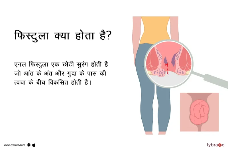 फिस्टुला के प्रकार: कारण, लक्षण और उपचार के विकल्प