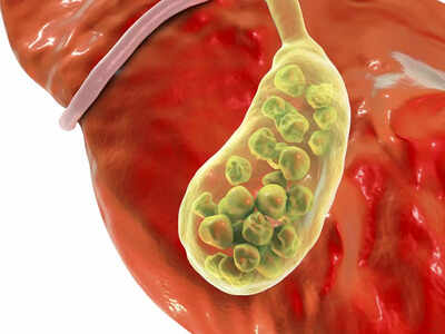 पित्ताशय की पथरी (Gallstones) का कारण, लक्षण और हिंदी में इलाज (Pittashay ki Pathri (Gallstones) ka Karan, Lakshan aur Hindi mein Ilaaj)