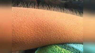 Goosebumps क्यों होते हैं? वैज्ञानिक कारण