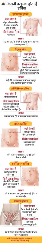 विभिन्न प्रकार के हर्निया: लक्षण और कारण