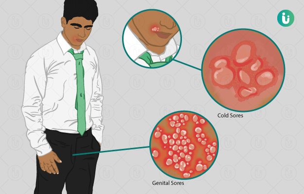 herpes meaning in hindi - Hình 2