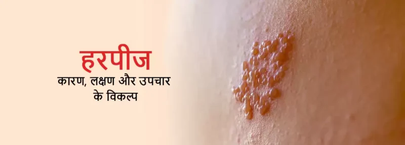 herpes meaning in hindi - Hình 3