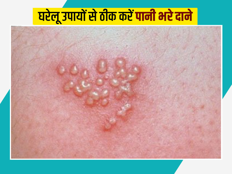 herpes meaning in hindi - Hình 4