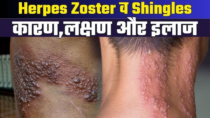 herpes meaning in hindi - Hình 5