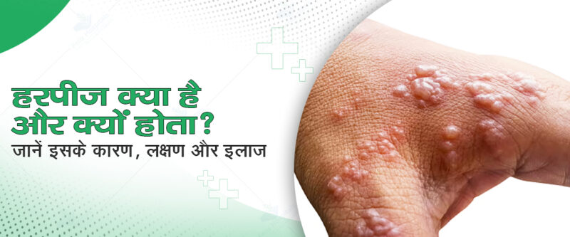 herpes meaning in hindi - Hình 1