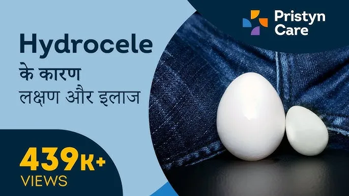 Hydrocele In Hindi Meaning: अंडकोष में पानी भरने के कारण, लक्षण और नवीनतम उपचार