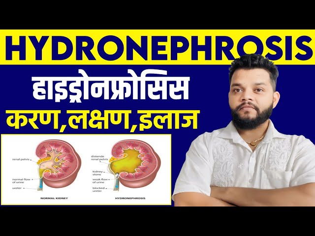 Hydronephrosis का हिंदी में अर्थ: एक व्यापक व्याख्या
