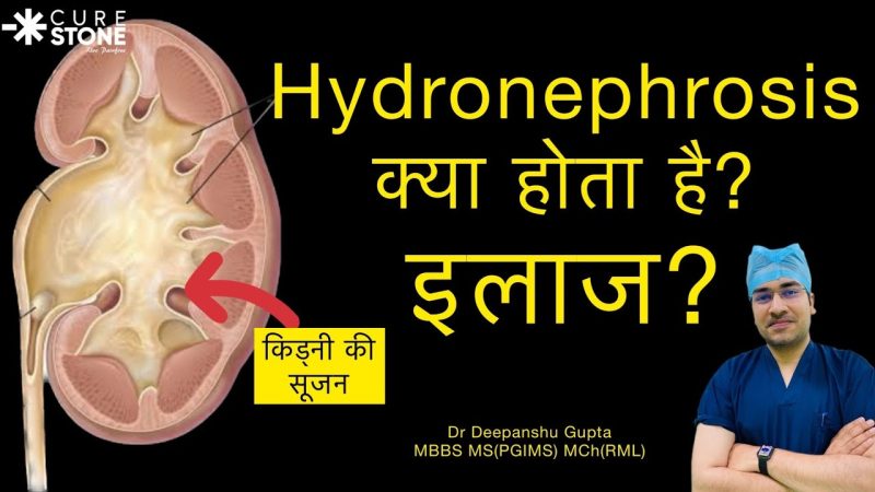 Hydronephrosis के कारण: हिंदी में जानकारी
