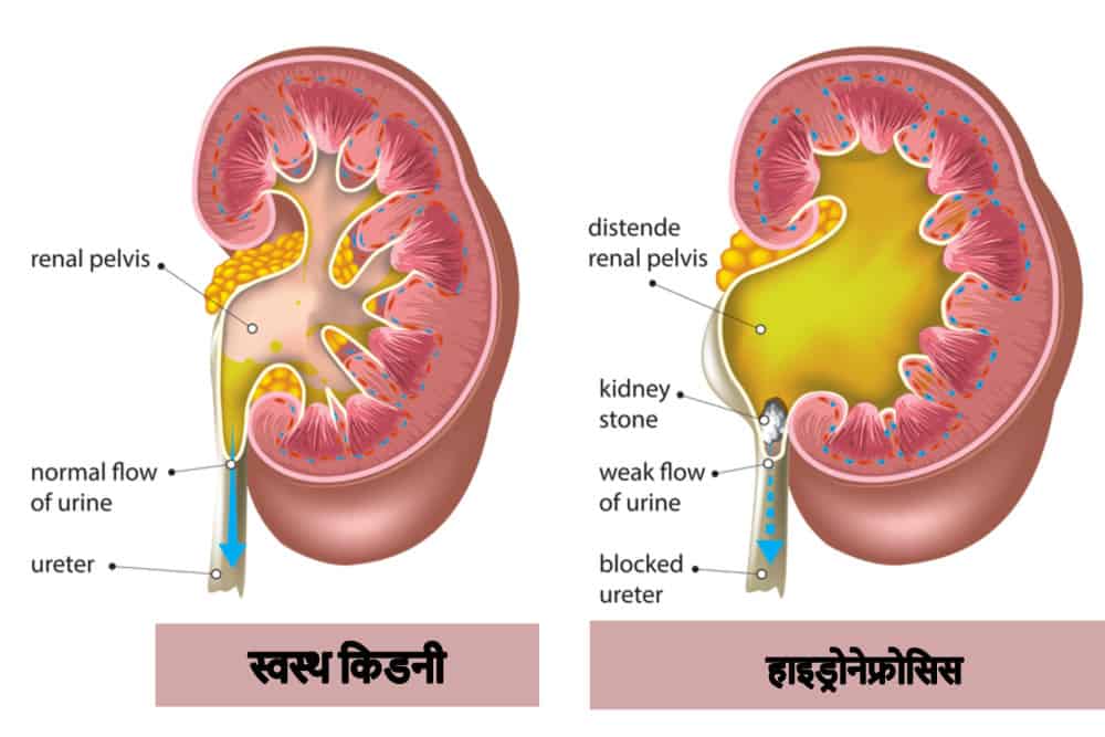 Hydronephrosis के लक्षण: पहचान और हिंदी में अर्थ