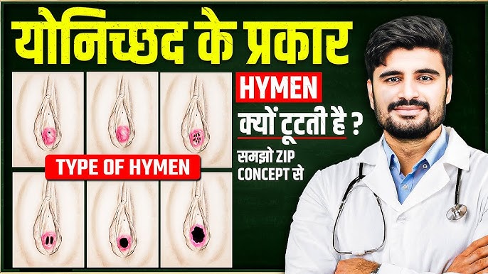 योनिच्छद के विभिन्न प्रकार और भिन्नताएं