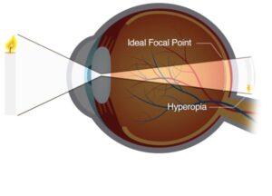 hypermetropia meaning in hindi