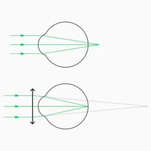 hypermetropia meaning in hindi - Hình 5