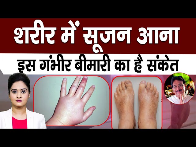 सूजन के कारण: संक्रमण से लेकर ऑटोइम्यून बीमारियों तक (सूजन किन कारणों से होती है?)