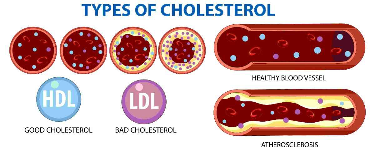 उच्च LDL कोलेस्ट्रॉल के कारण और जोखिम कारक