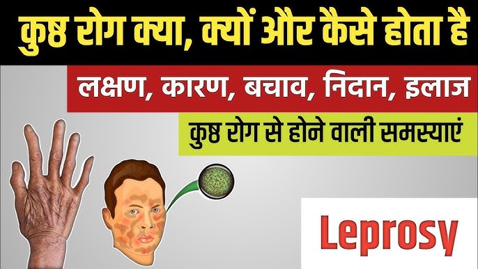 कुष्ठ रोग का निदान, उपचार और रोकथाम के उपाय