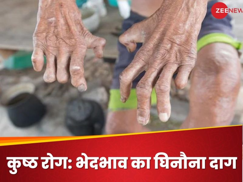 कुष्ठ रोग: मिथक, तथ्य और सामाजिक प्रभाव