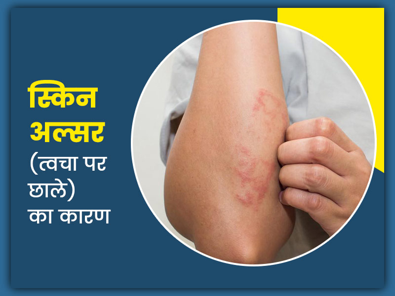 lesion meaning in hindi 3