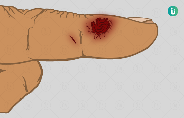 lesion meaning in hindi 4