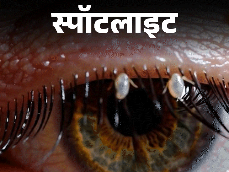जूँ (Lice) के लक्षण और संकेतों की पहचान कैसे करें?
