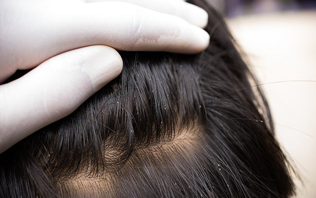 सिर की जूँ (Head Lice) का निदान और परीक्षण