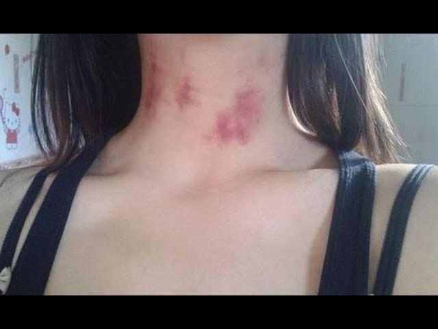 लव बाइट से छुटकारा पाने के घरेलू उपाय (Love Bite se chutkara paane ke gharelu upaay)