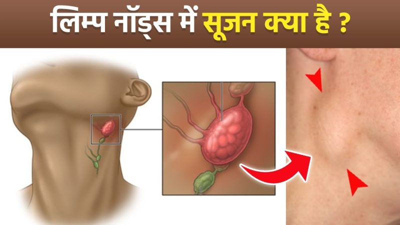 लिम्फ नोड्स में सूजन के लक्षण (Lymph nodes mein soojan ke lakshan)