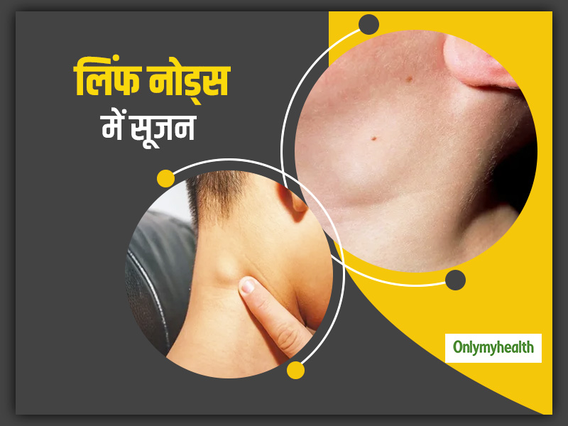 लिम्फ नोड्स में सूजन का निदान और उपचार (Lymph nodes mein soojan ka nidaan aur upchar)