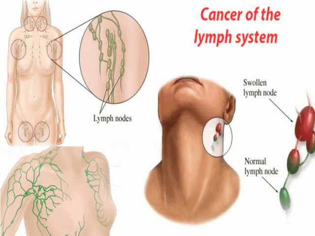 लिम्फैडेनोपैथी के मुख्य कारण: संक्रमण से लेकर अन्य बीमारियाँ (Lymphadenopathy Ke Mukhya Karan: Sankraman Se Lekar Anya Bimariyan)