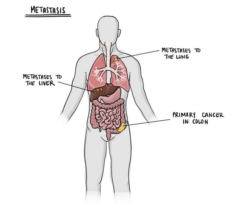 सौम्य (Benign) और घातक (Malignant) ट्यूमर में अंतर (Difference Between Benign and Malignant Tumors)